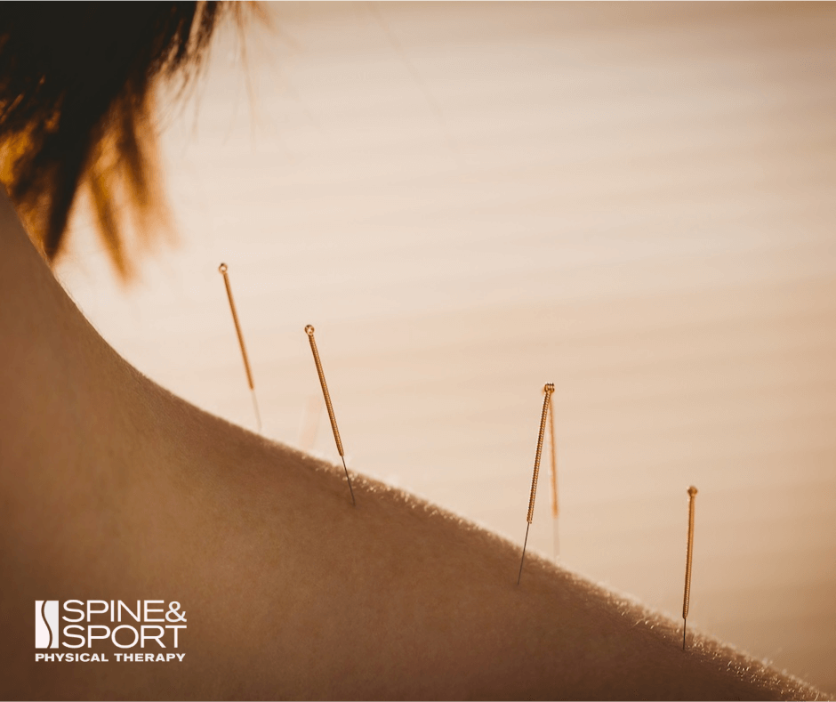 image of a person on a dry needle session